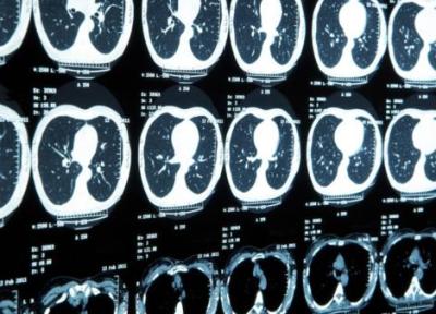 MRI نانویی می تواند سرطان را زودهنگام شناسایی کند