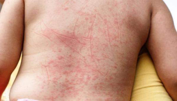 دلیل و علائم تب اسکارلت در نوزادان و بچه ها چیست؟